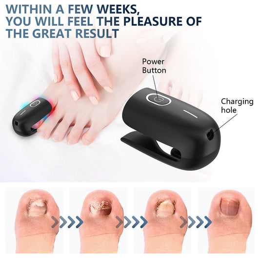 🔥NEW YEAR Blowout Sale! – Buy Two for Only $129, Hurry!🔥- Kill Nail Fungus in 7 minutes Antifungal Laser Device